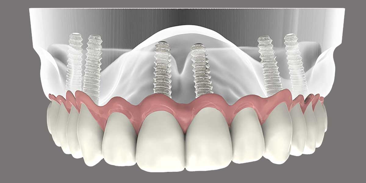 implant supported dentures image