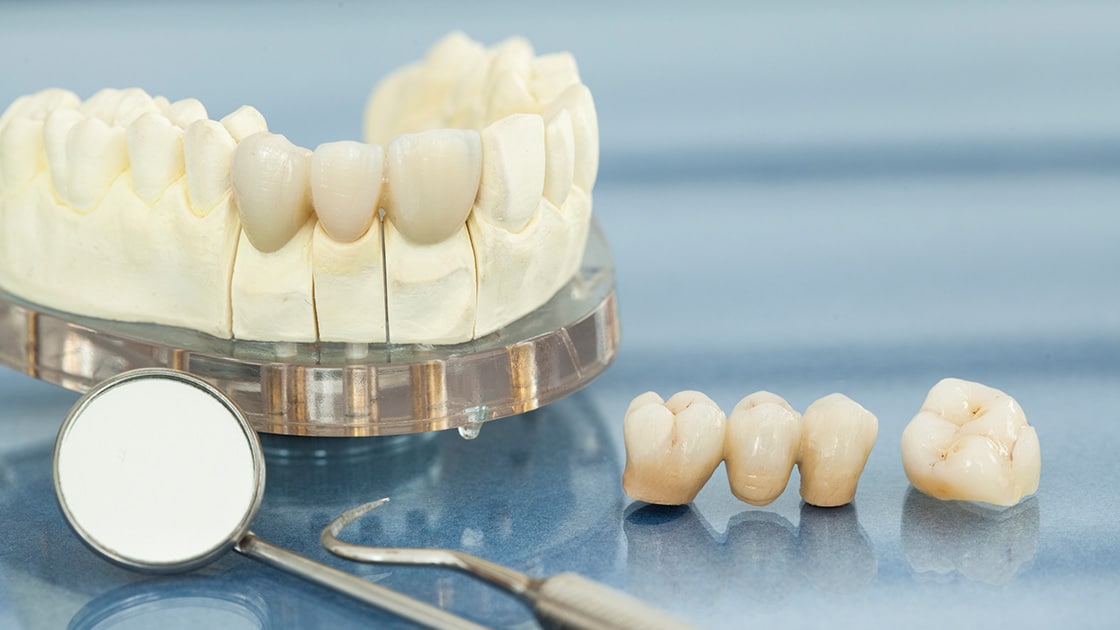 Dental Bridge image