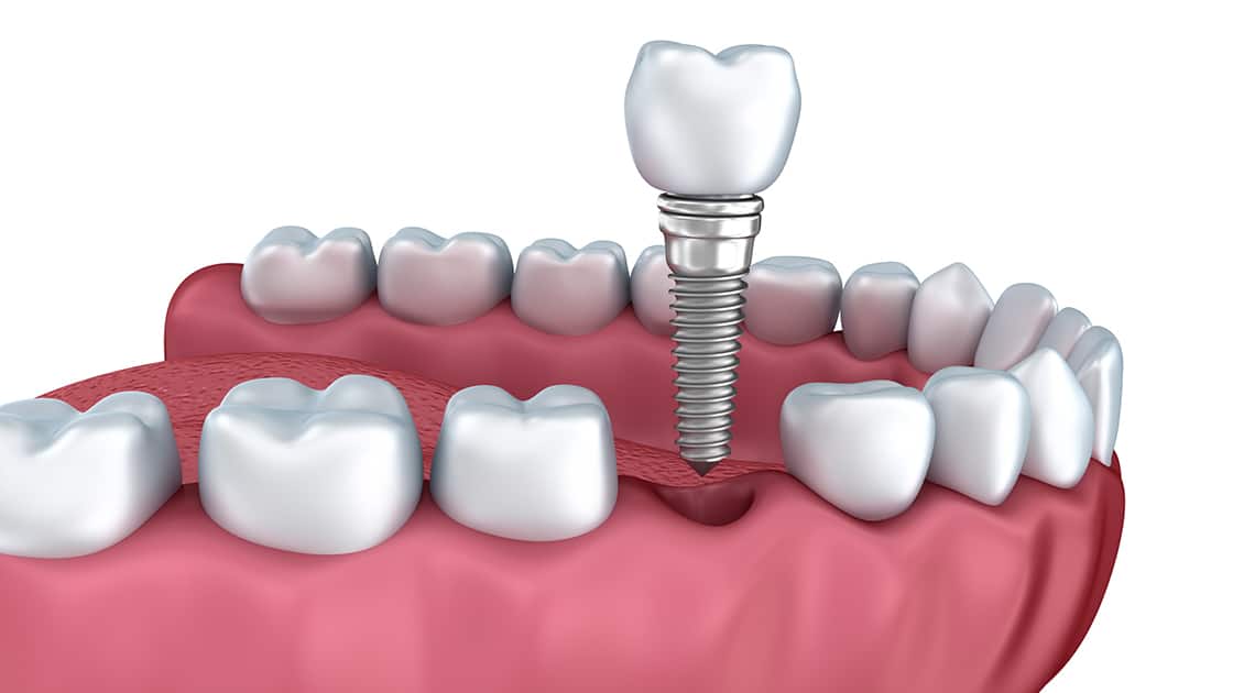 dental implant digital rendering