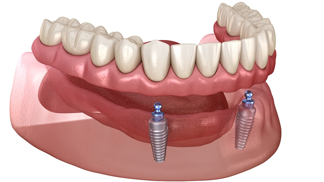 Overdenture Implant image