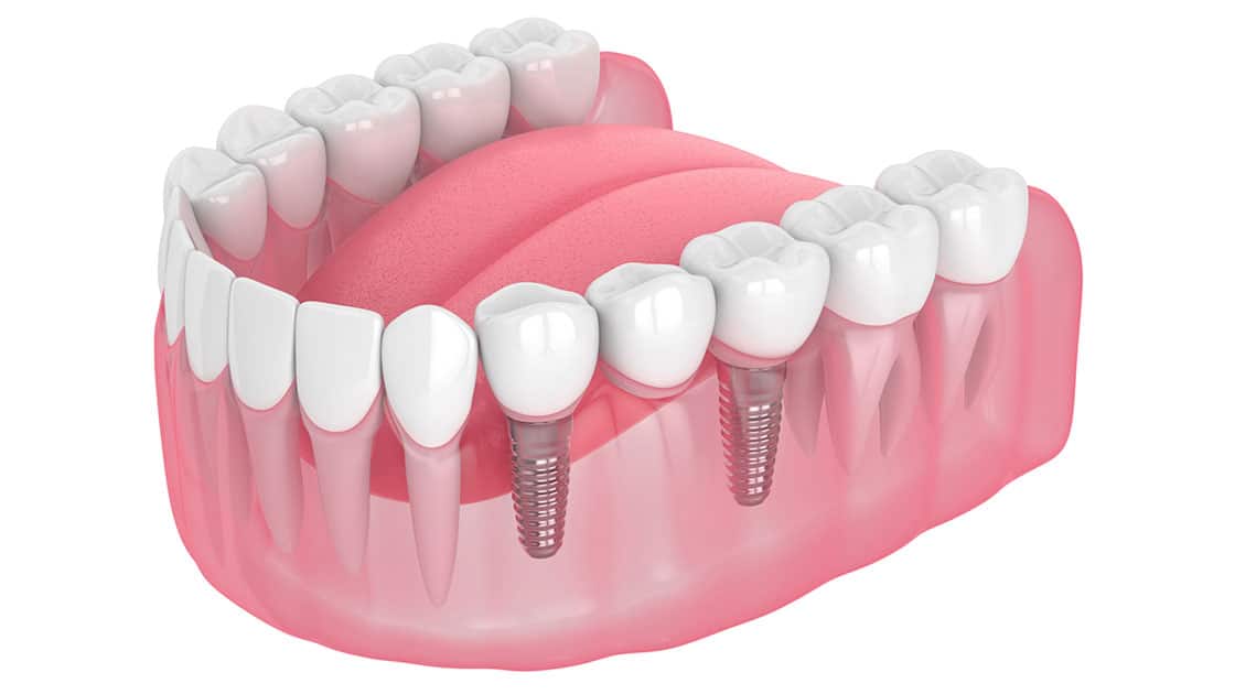 dental implant supported bridge digital rendering