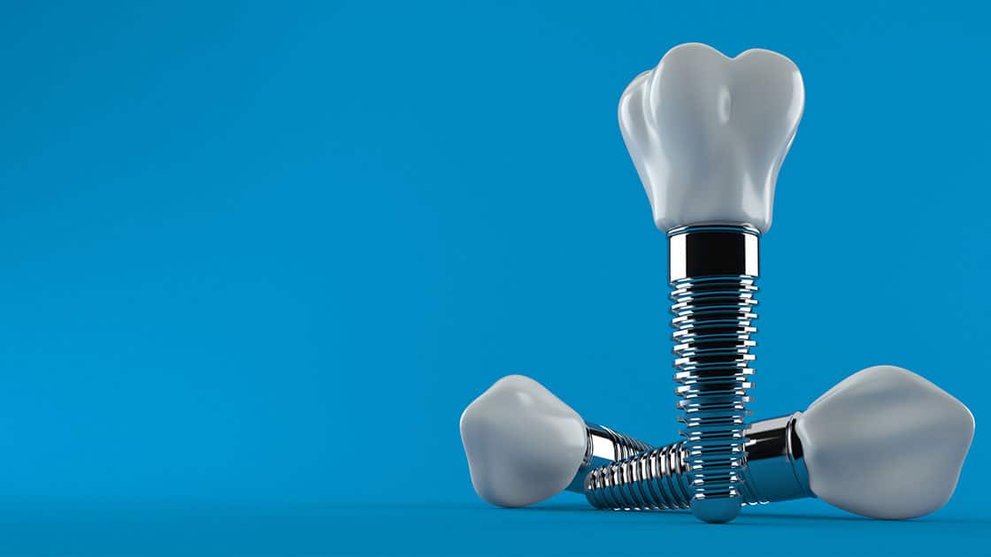 Dental implants digital rendering