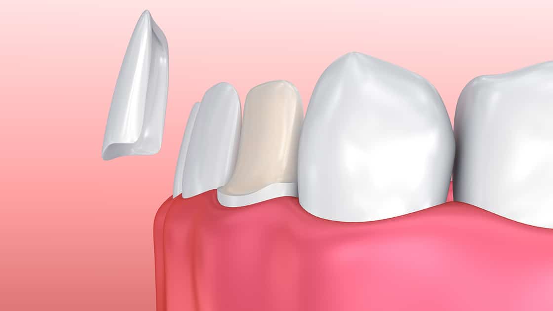 digital rendering showing dental veneer